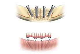 Figure 4:  4 implants dans la mandibule