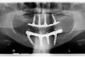 Figure 5: radiographie panoramique de 4 implants dans la mandibule