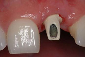 Figure 7: remplacement d'une dent manquante par 1 implant: photo du pilier vissé sur l'implant