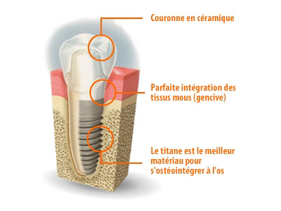 Implantologie axiale